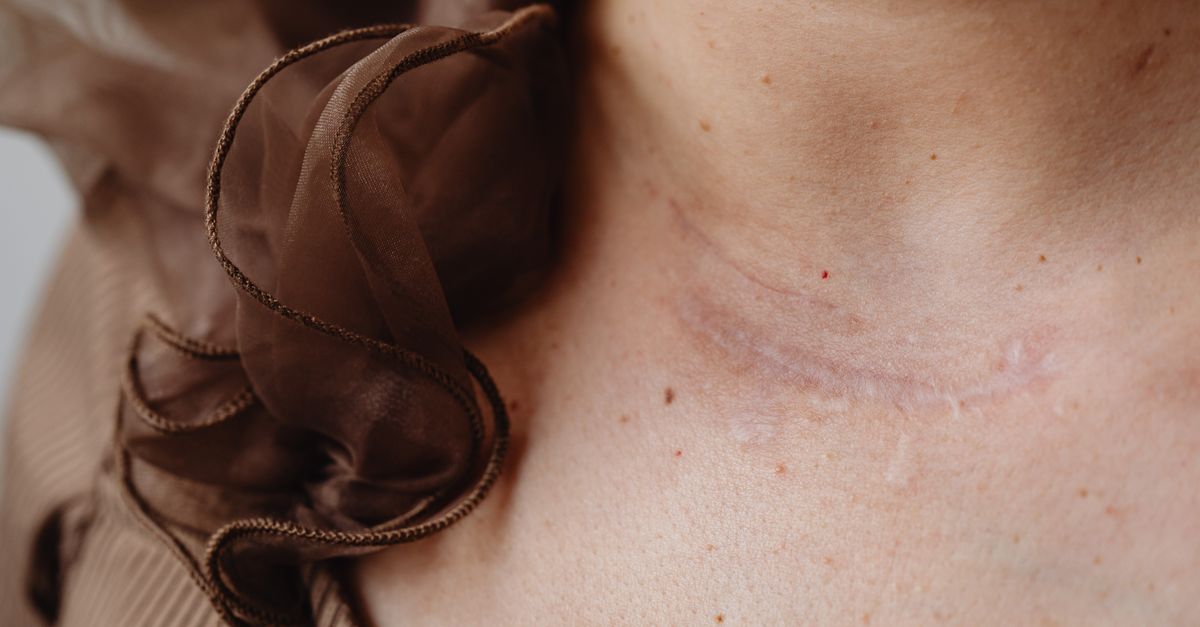 Close-up image of a neck scar with surrounding delicate brown fabric, highlighting skin texture and detail.