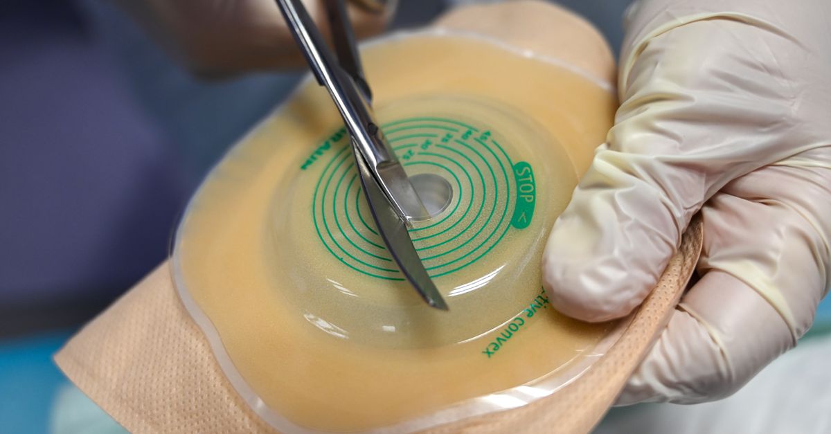 Nurse using scissors to customize an ostomy pouch for patient care.