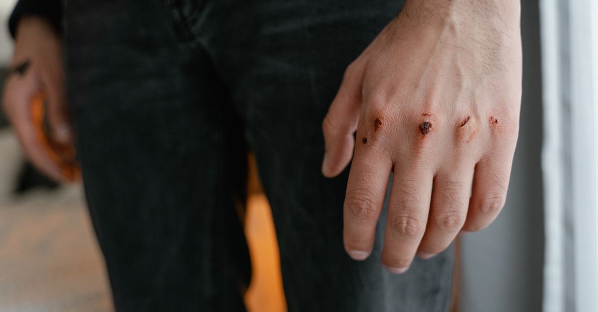 Detailed image of a hand with visible wounds and scratches, emphasizing injury.