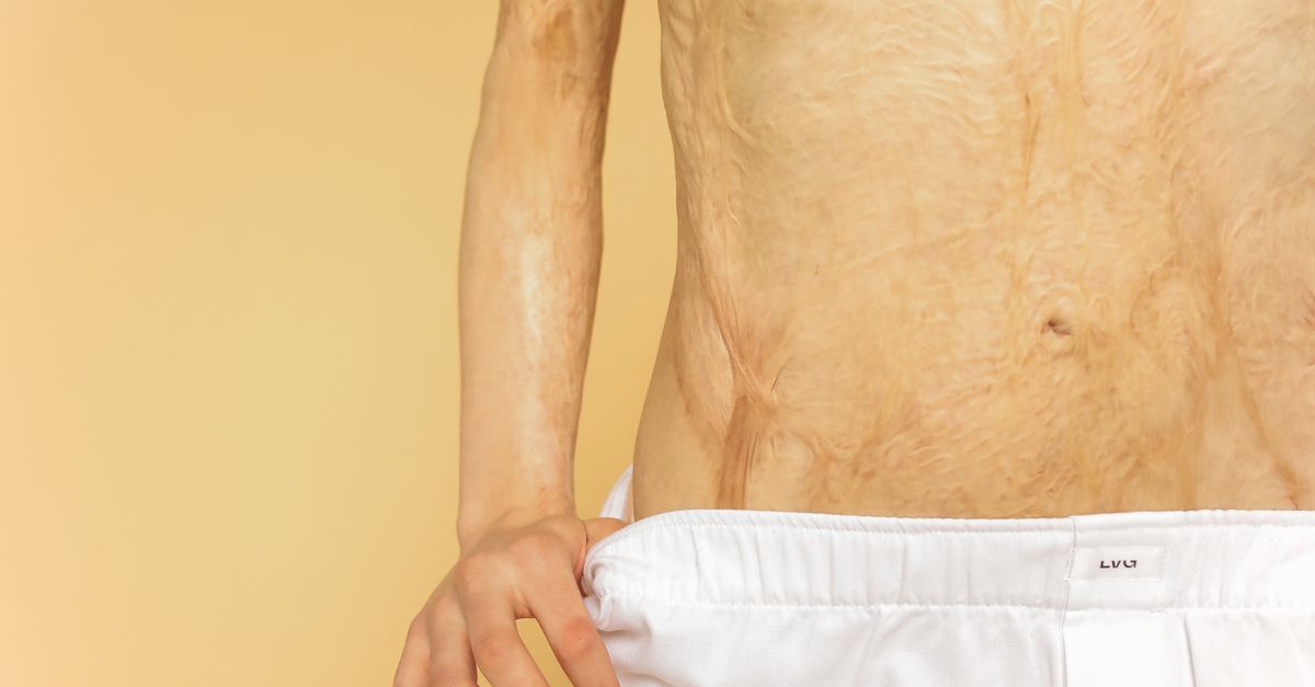 Detailed close-up of a torso with visible burn scars against a neutral background.