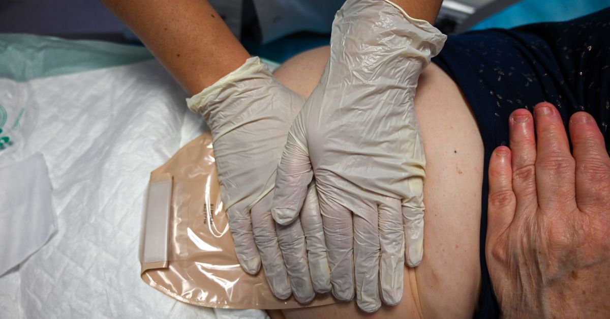 Nurse wearing gloves changes an ostomy pouch on a patient in a medical setting.