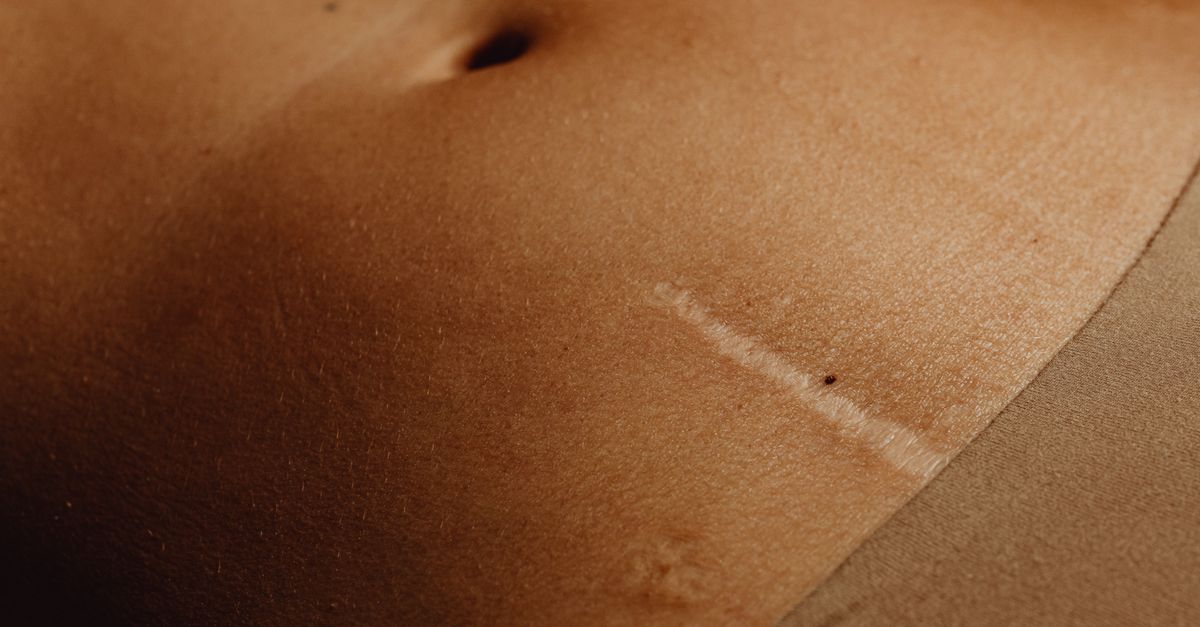 Detailed close-up of a woman's abdomen showing a scar and moles, highlighting skin texture.